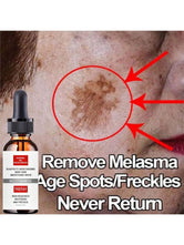 Effective Skin Lightening Cream 5ml/15ml/30ml/50ml/100ml Remove Burns Freckles Dark Spots Exfoliate Anti-Pigmentation Improve Skin Paleness