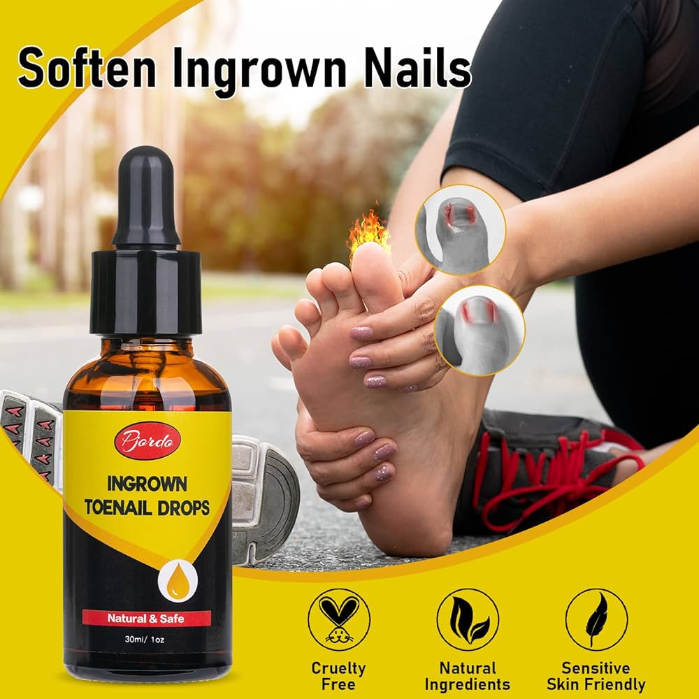 30ML Ingrown Toenail Treatment,nail Growth Treatment,ingrown Toenail